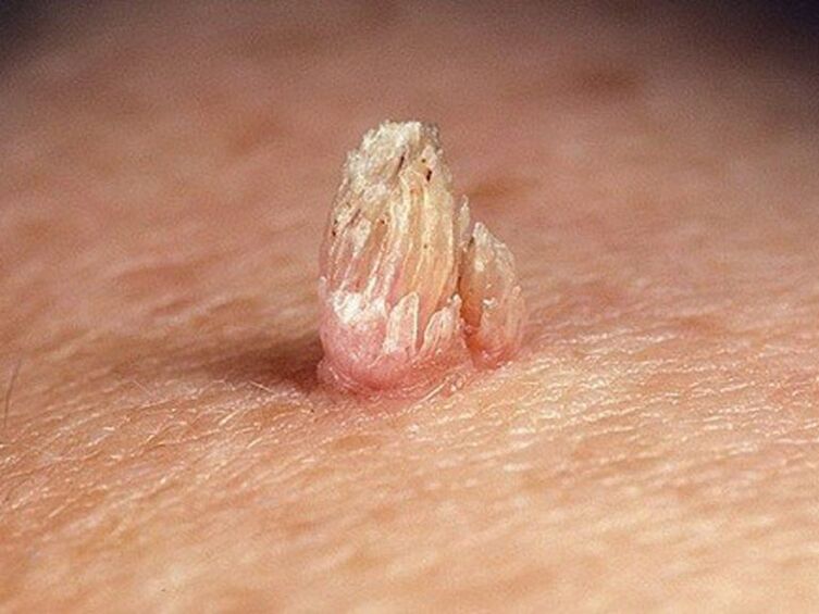 ခန္ဓာကိုယ်ပေါ်တွင်လိင်အင်္ဂါ papilloma
